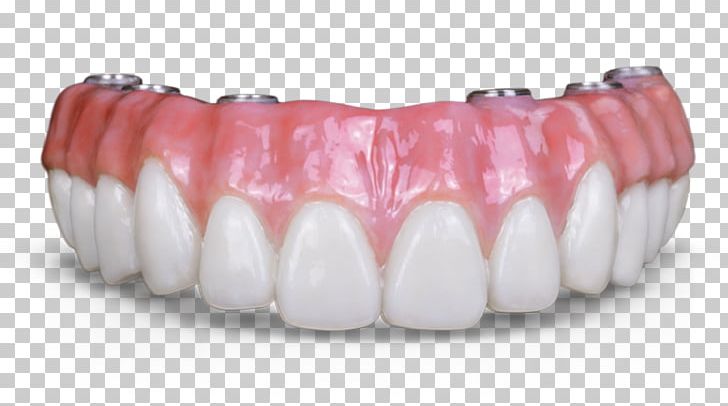 Dental Implant Dentures Dentistry Prosthesis Fixed Prosthodontics PNG, Clipart, Abutment, Allon4, Bridge, Crown, Dental Implant Free PNG Download