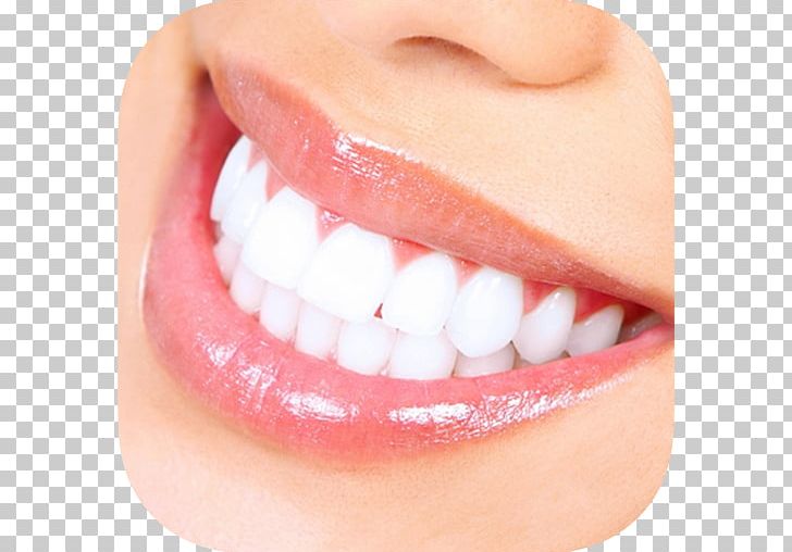 Tooth Whitening Dentistry Human Tooth PNG, Clipart, Chin, Closeup, Cosmetic Dentistry, Cracked Tooth Syndrome, Dental Hygienist Free PNG Download