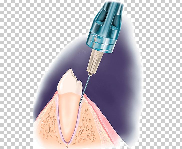 Dentistry Local Anesthesia Dental Anesthesia Local Anesthetic PNG, Clipart, Anesthesia, Anesthetic, Dental Anesthesia, Dentist, Dentistry Free PNG Download