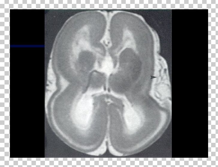 Computed Tomography Brain Radiology Magnetic Resonance Imaging Lääketieteellinen Röntgenkuvaus PNG, Clipart, Bone, Centimeter, Cerebral Hemisphere, Computed Tomography, Digital Radiography Free PNG Download