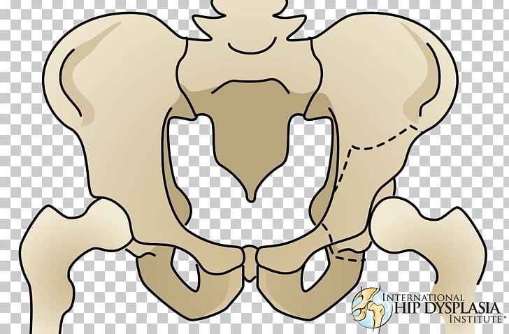 Osteotomy Hip Dysplasia Acetabulum Pelvis PNG, Clipart, Arm, Bone, Carnivoran, Cartoon, Cat Like Mammal Free PNG Download