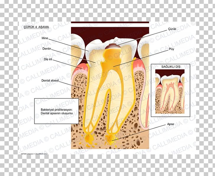 Dental Abscess Tooth Brushing Dentist PNG, Clipart, Abscess, Dental Abscess, Dental Calculus, Dental Plaque, Dentin Free PNG Download