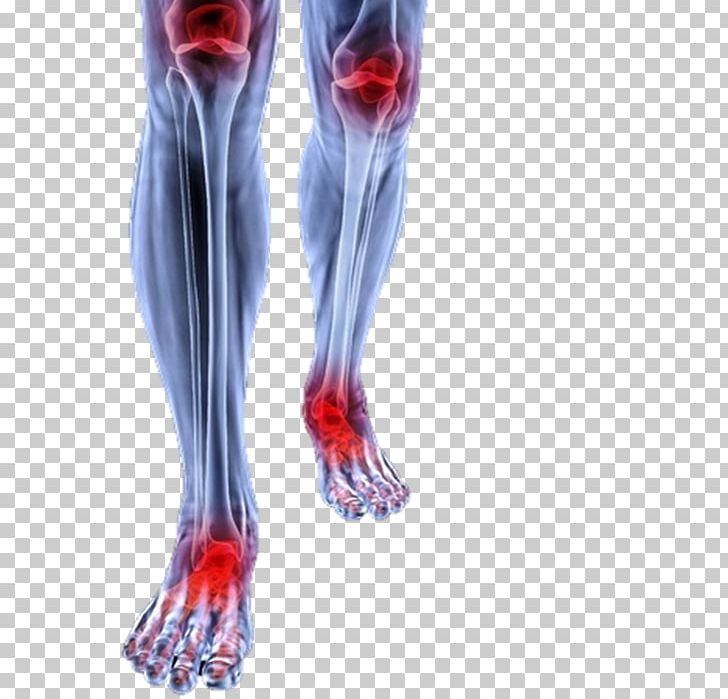 Knee Pain Podalgia Calf Sole PNG, Clipart, Ache, Ankle, Arm, Back Pain, Calf Free PNG Download
