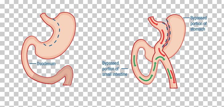 Duodenal Switch Bariatric Surgery Duodenum Gastric Bypass Surgery PNG, Clipart, Bariatrics, Bariatric Surgery, Bypass Surgery, Diabetes Mellitus Type 2, Duodenal Switch Free PNG Download