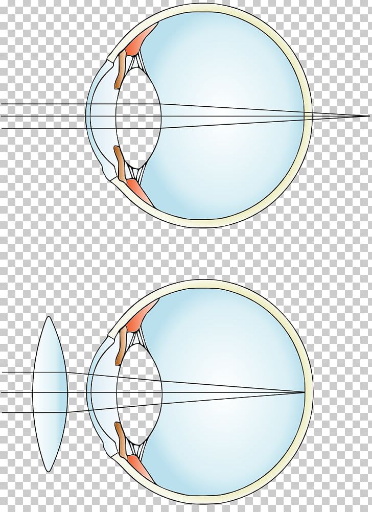 Far-sightedness Near-sightedness Corrective Lens Eye PNG, Clipart, Angle, Area, Astigmatism, Circle, Contact Lenses Free PNG Download