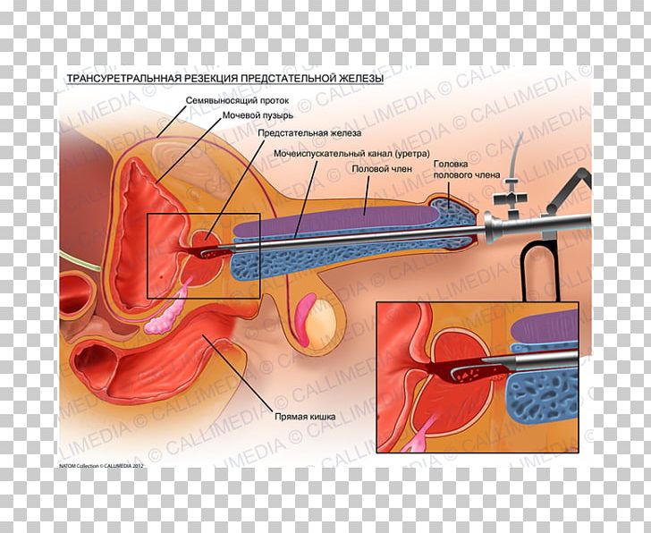 Transurethral Resection Of The Prostate Prostate Cancer Benign Prostatic Hyperplasia Surgery PNG, Clipart, Angle, Benign Prostatic Hyperplasia, Cancer, Catheter, Ear Free PNG Download