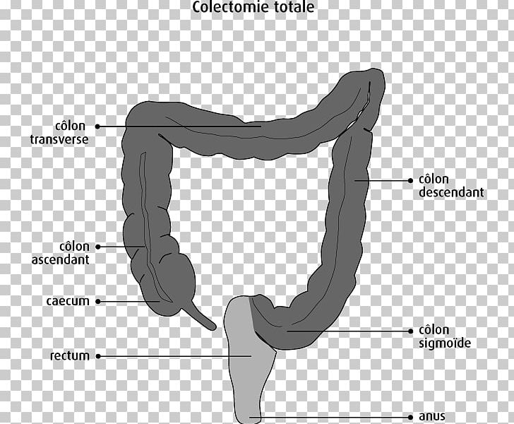 Colectomy Bowel Resection Lower Anterior Resection Surgery Ileo-anal Pouch PNG, Clipart, Angle, Arm, Bowel Resection, Colectomy, Colorectal Cancer Free PNG Download