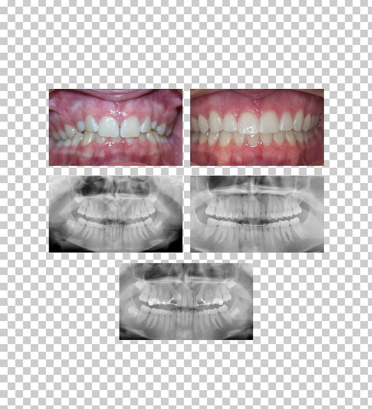 Palatine Mount Prospect Arlington Orthodontics Dental Braces PNG, Clipart, Adolescence, Adult, Arlington Heights, Child, Chris Pugeda Dmd Free PNG Download
