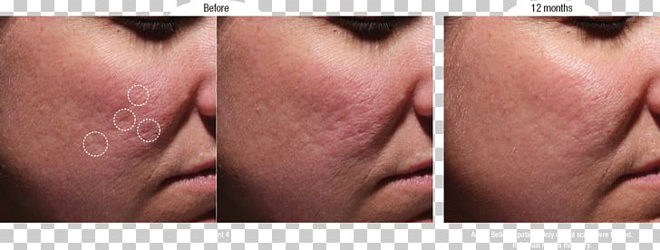 Cheek Scar Acne Injectable Filler Therapy PNG, Clipart, Before, Cheek, Chin, Closeup, Collagen Induction Therapy Free PNG Download
