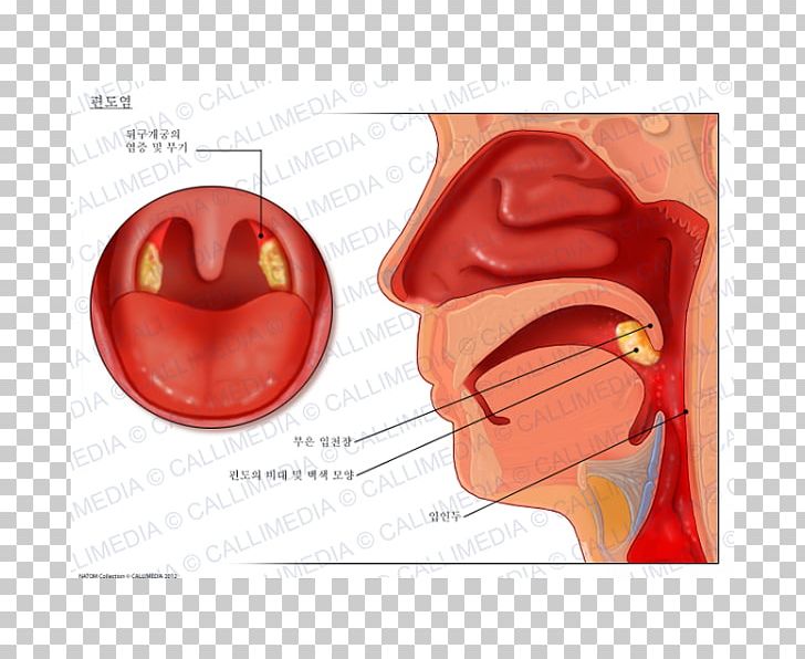 Tonsillitis Otorhinolaryngology Oropharynx Oropharyngeal Cancer PNG, Clipart, Anatomy, Disease, Ear, Heart, Jaw Free PNG Download