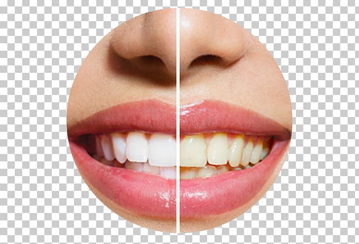 Lee And Van Mieghem DDS Cosmetic Dentistry Tooth Whitening PNG, Clipart, Chin, Clear Aligners, Cosmetic Dentistry, Dental Sealant, Dentist Free PNG Download