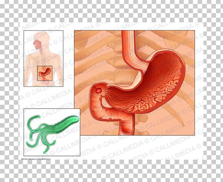 Helicobacter Pylori Peptic Ulcer Disease Duodenum Pylorus Stomach PNG, Clipart, Disease, Duodenum, Ear, Gastric Acid, Gastritis Free PNG Download