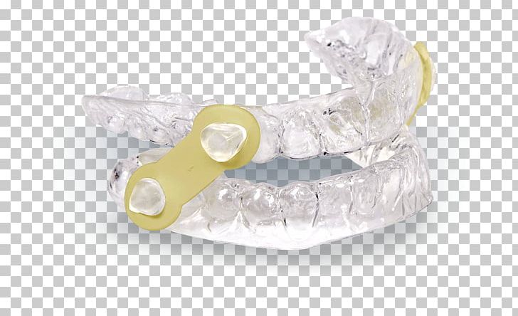 Mandibular Advancement Splint Mandible Dentistry Snoring Jaw PNG, Clipart, Advancement, Apnea, Appliances, Crystal, Dentist Free PNG Download