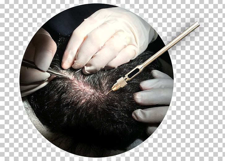 Hair Transplantation Acıbadem Fulya Hospital Acıbadem Healthcare Group Capelli PNG, Clipart, Capelli, Finger, Hair, Hair Care, Hair Transplantation Free PNG Download