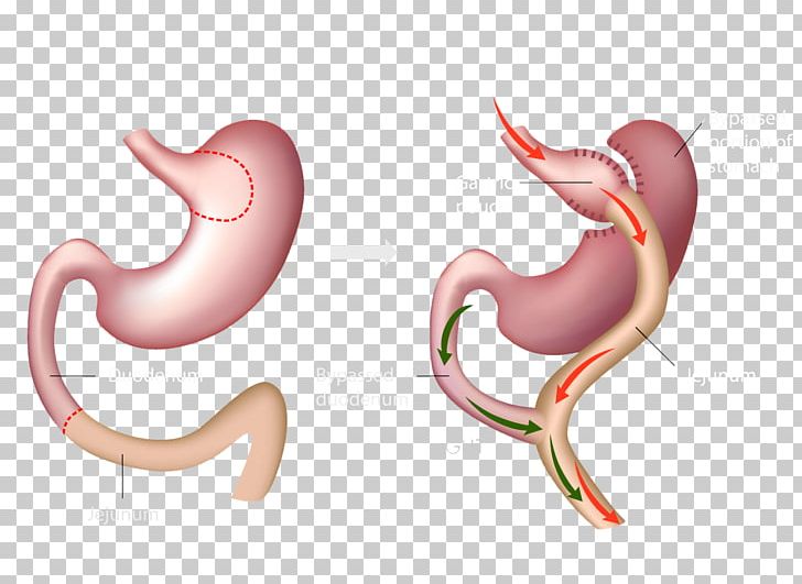 Gastric Bypass Surgery Bariatric Surgery Roux-en-Y Anastomosis Sleeve Gastrectomy PNG, Clipart, Bariatrics, Body Jewelry, Bypass, Bypass Surgery, Duodenal Switch Free PNG Download