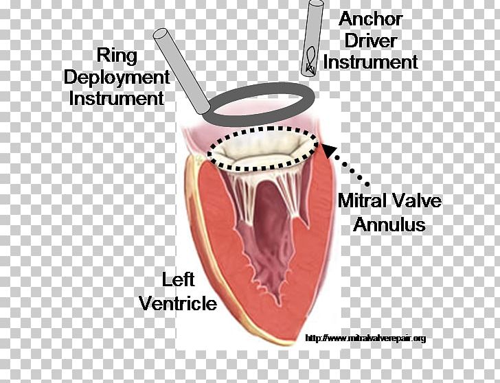Mitral Valve Annuloplasty Mitral Valve Repair Heart Valve PNG, Clipart, Catheter, Heart, Heart Valve Repair, Jaw, Mitral Insufficiency Free PNG Download