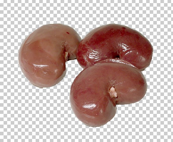 real human kidney stone