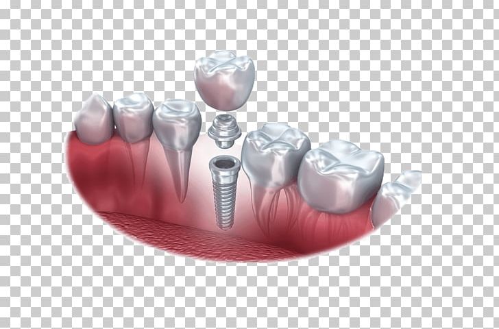 Dental Implant Dentistry Tooth PNG, Clipart, Bridge, Cosmetic Dentistry, Crown, Dental Implant, Dental Surgery Free PNG Download