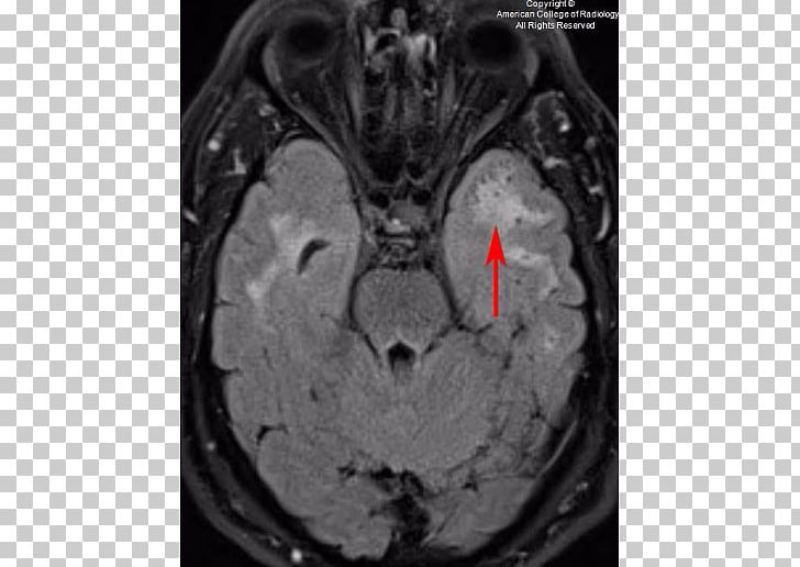 Computed Tomography Brain Organism PNG, Clipart, Black And White, Brain, Cadasil, Computed Tomography, Jaw Free PNG Download