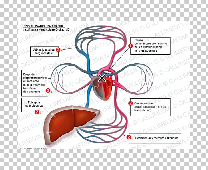 Heart Failure Right Ventricle Lung Electrocardiography PNG, Clipart, Cardiology, Cardiovascular Disease, Diagram, Diastole, Dyspnea Free PNG Download