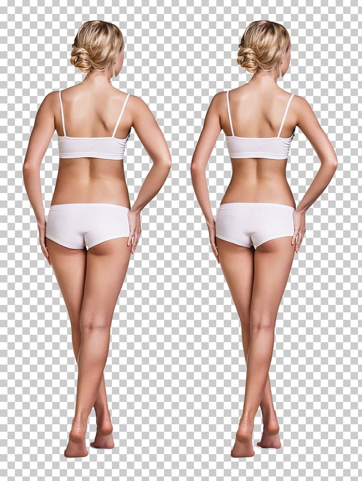 Weight Loss Model Adipose Tissue Fat Emulsification PNG, Clipart, Abdomen, Active Undergarment, Arm, Before, Brassiere Free PNG Download