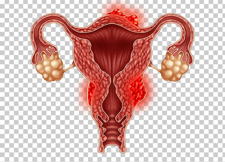 Ovary Uterine Fibroid Laparoscopy Uterus Gynaecology PNG, Clipart, Cervical Cancer, Estrogen, Fertilisation, Flesh, Gynaecology Free PNG Download