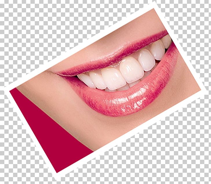 Tooth Dentistry Dental Prosthesis American Dental Association PNG, Clipart, American Dental Association, Artistry, Blog, Cosmetic Dentistry, Cosmetics Free PNG Download