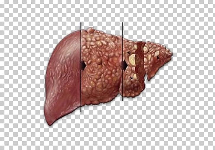 Liver Disease Hepatitis C Infectious Disease PNG, Clipart, Chronic Liver Disease, Disease, Flesh, Hepatitis, Hepatitis B Free PNG Download