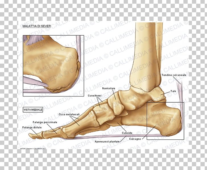 Foot Köhler Disease Bone Osteochondrosis PNG, Clipart, Ankle, Arm, Bone, Calcaneus, Cuboid Bone Free PNG Download