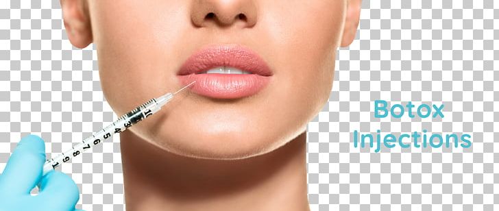 Lip Augmentation Injection Botulinum Toxin Injectable Filler Wrinkle PNG, Clipart, Aesthetic Medicine, Antiaging Cream, Beauty, Botox, Botulinum Toxin Free PNG Download