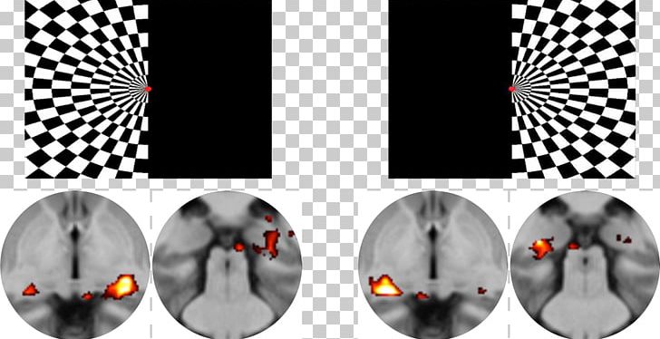 The Pusher Film Series Large Scale Brain Networks Pusher Syndrome Pusher-Symptomatik Pattern PNG, Clipart, Algorithm, Analysis, Joint, Large Scale Brain Networks, Machine Learning Free PNG Download