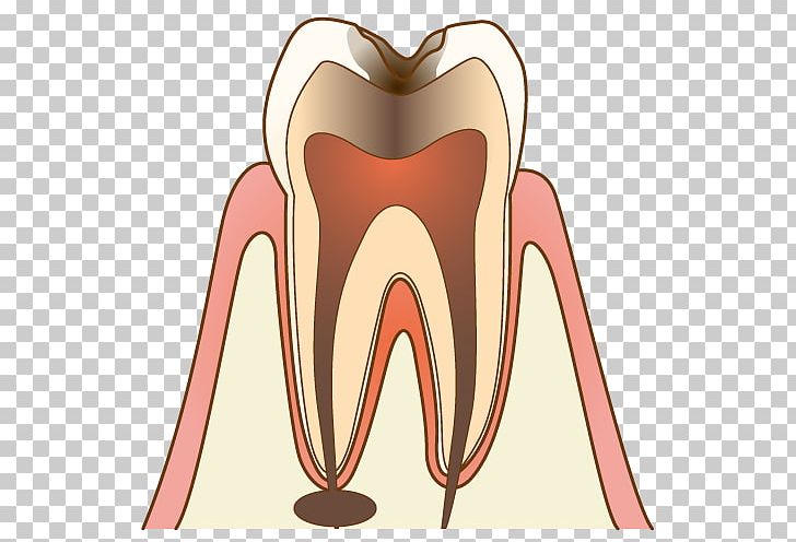 歯科 Dentist Tooth Decay Therapy 医院 PNG, Clipart, Ache, Decayed Tooth, Dental Calculus, Dentist, Dentures Free PNG Download