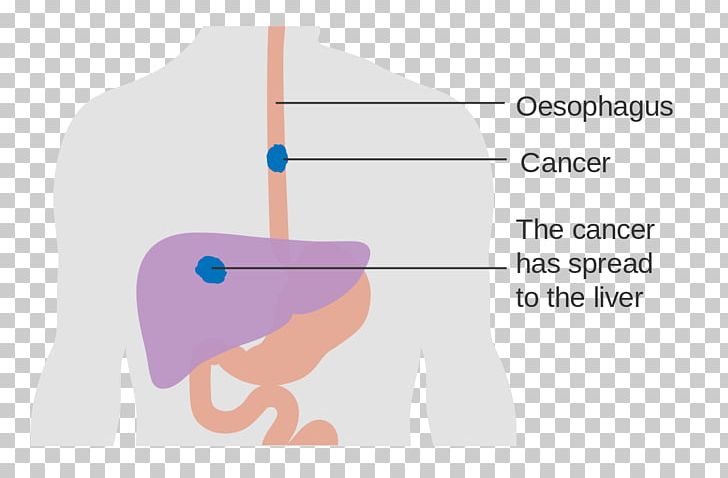 Esophageal Cancer Esophagus Dysphagia Disease PNG, Clipart, Achalasia, Angle, Brand, Cancer, Diagram Free PNG Download