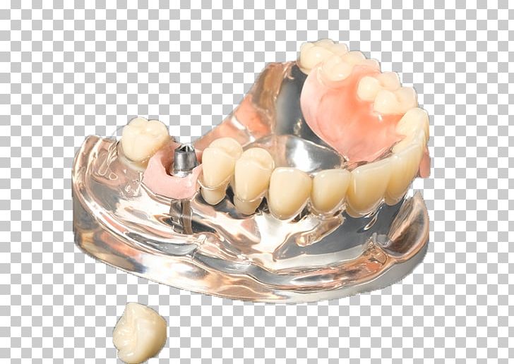 Medic Company Limited Crown Business Tooth Dental Implant PNG, Clipart, Business, Clam, Clams Oysters Mussels And Scallops, Crown, Dental Implant Free PNG Download