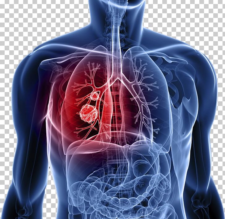 lung-cancer-symptom-metastasis-png-clipart-cancer-cancer-staging