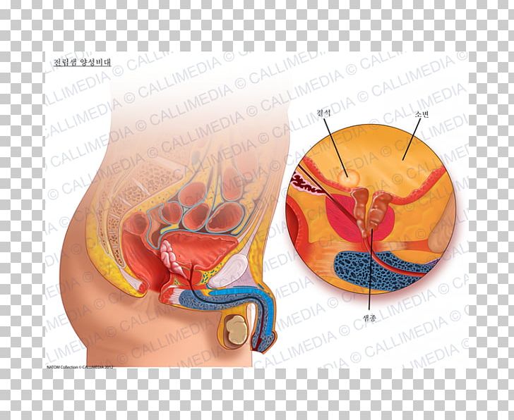 Papillary lesion prostate. Papillary lesion prostate, Papillary lesion in bladder