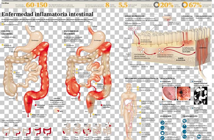 Inflammatory Bowel Disease Crohn's Disease Ulcerative Colitis Intestine PNG, Clipart,  Free PNG Download