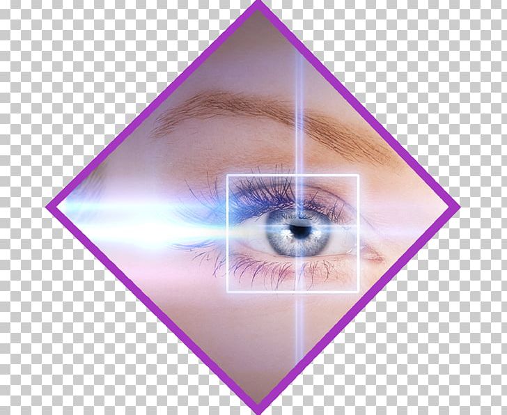 LASIK Eye Surgery Cataract PNG, Clipart, Angle, Cataract, Cataract Surgery, Circle, Contact Lenses Free PNG Download