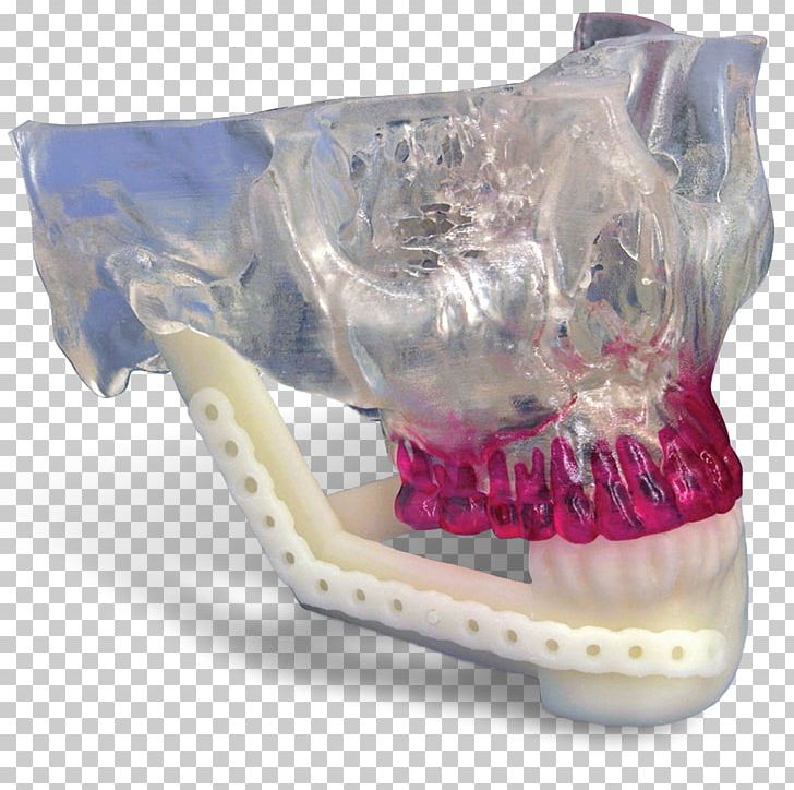 Mandible Jaw Mandibular Reconstruction Maxilla Surgery PNG, Clipart, 3d Systems, 3d Systems Gmbh, Implant, Jaw, Mandible Free PNG Download