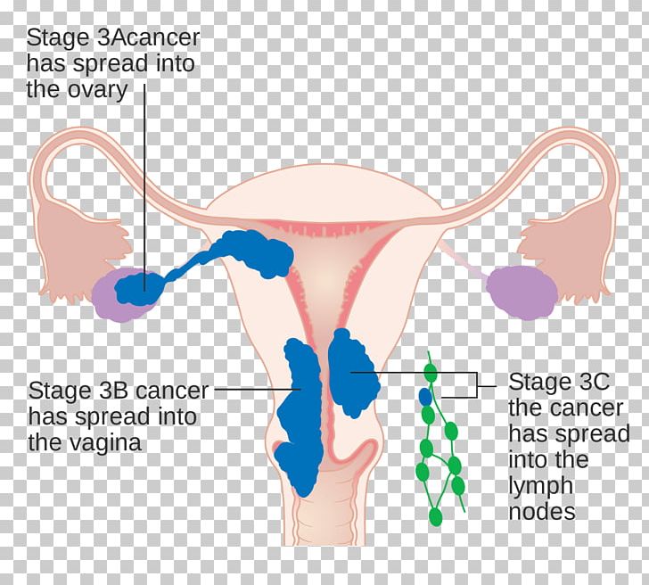 Uterine Cancer Endometrial Cancer Endometrium Cancer Staging PNG, Clipart, Abdomen, Angle, Arm, Cancer, Cancer Staging Free PNG Download