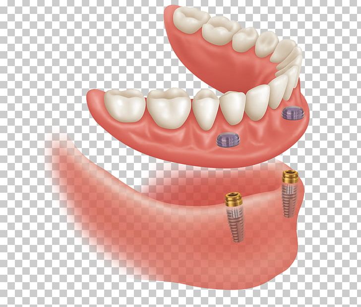 Dental Implant Dentures Dentistry Abutment PNG, Clipart, Chin, Cosmetic Dentistry, Dental, Dental Laboratory, Dentist Free PNG Download
