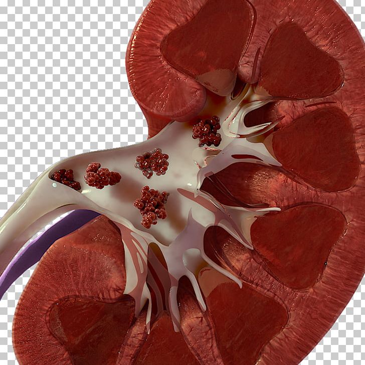 Ureteral Cancer Urethral Cancer Medicine PNG, Clipart, Bladder, Cancer ...