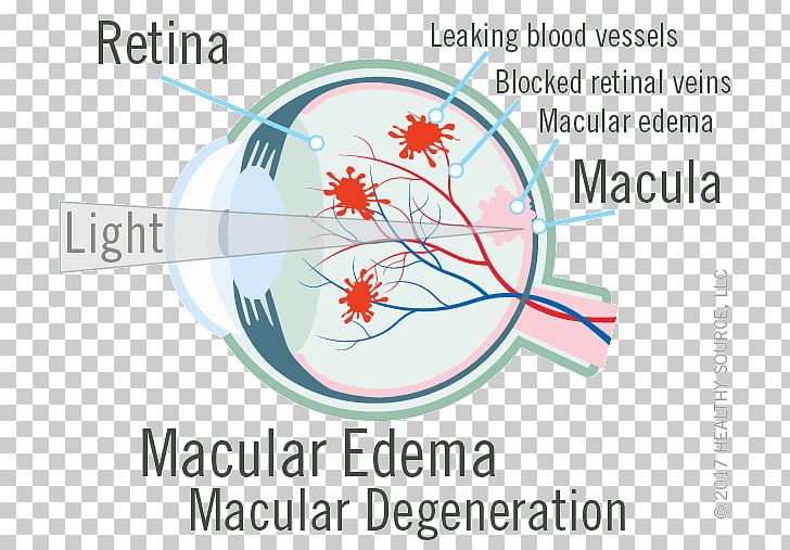 Macula Of Retina Macular Edema Central Retinal Vein Occlusion PNG, Clipart, Anatomy, Area, Blood, Blood Vessel, Capillary Free PNG Download