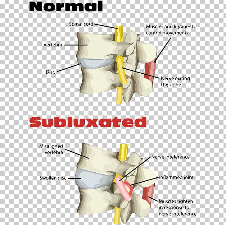 Chiropractic Treatment Techniques Spinal Adjustment Alternative Health Services Health Care PNG, Clipart, Alternative Health Services, Angle, Back Pain, Chiropractic, Chiropractic Treatment Techniques Free PNG Download