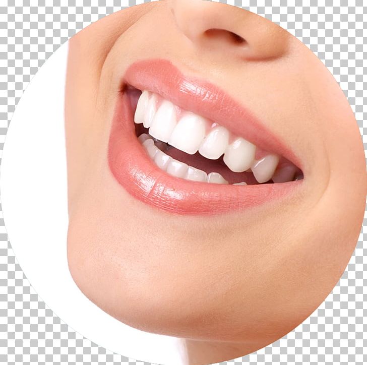 Tooth Whitening Dentistry Human Tooth PNG, Clipart, Bridge, Cheek, Chin, Closeup, Cosmetic Dentistry Free PNG Download