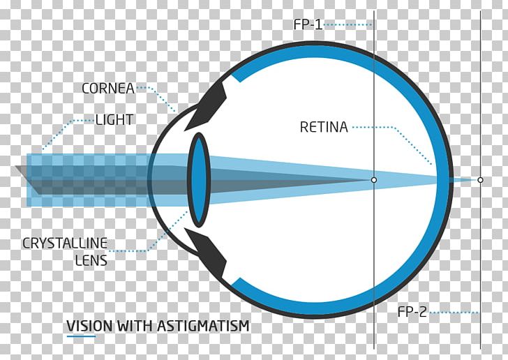 Floater Presbyopia Visual Perception Nd:YAG Laser Eye PNG, Clipart, Angle, Astigmatism, Blurred Vision, Capsulotomy, Circle Free PNG Download