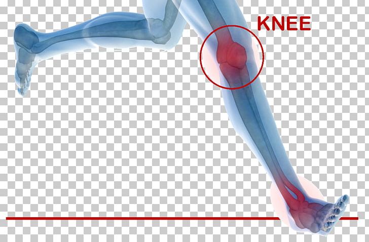 Orthopedic Surgery Knee Replacement Joint Replacement Therapy PNG, Clipart, Angle, Arm, Arthritis, Clinic, Human Leg Free PNG Download