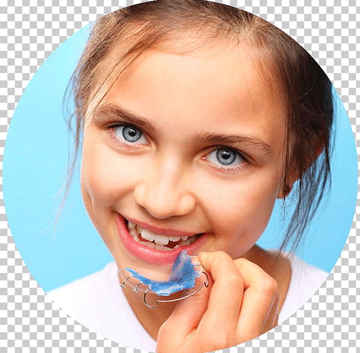 Orthodontics Dentistry Clear Aligners Retainer Dental Braces PNG, Clipart, Cheek, Child, Chin, Dent, Dental Surgery Free PNG Download