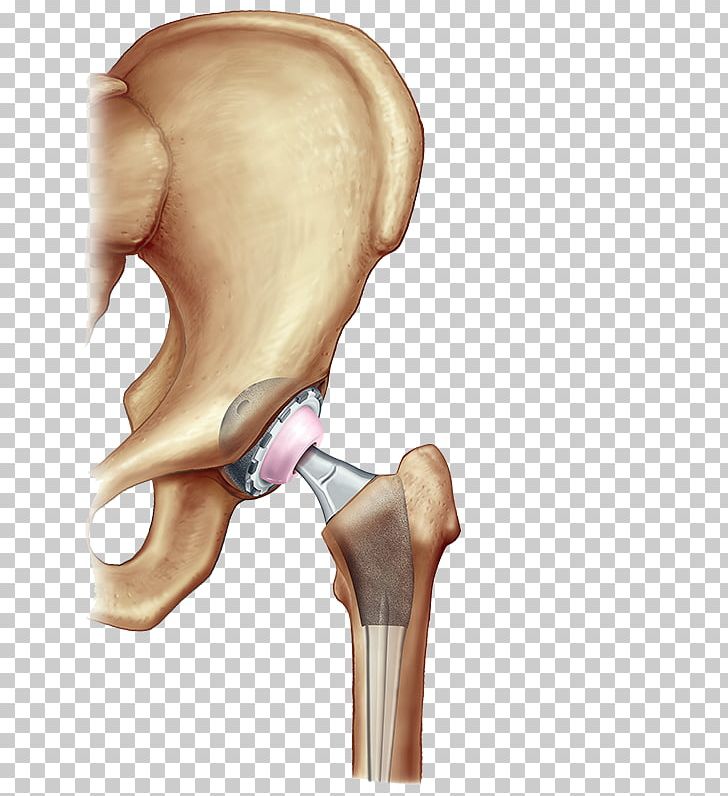 Hip Replacement Surgery Knee Replacement Joint Replacement PNG, Clipart, Ache, Arm, Arthritis, Bone, Ear Free PNG Download