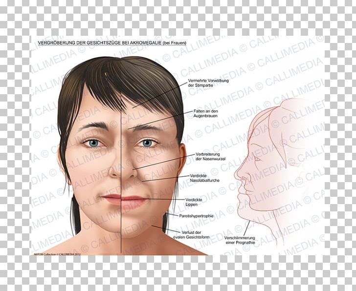 Acromegaly Face Gigantism Growth Hormone PNG, Clipart, Acromegaly, Angle, Cheek, Chin, Ear Free PNG Download